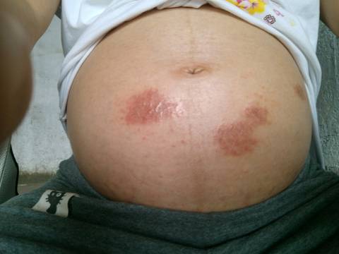 怀孕26周肚子疤,时不时痒怎麼办