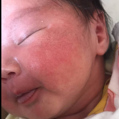 婴儿脸上长奶癣图片图片