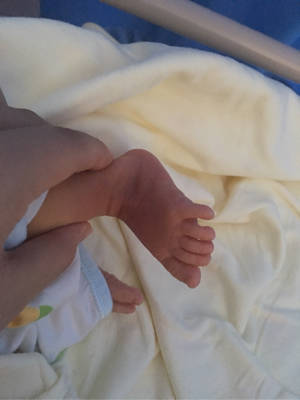 六个月宝宝脚外撇图片图片