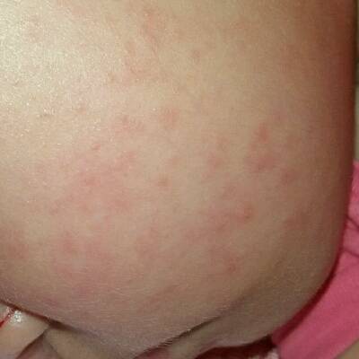 婴儿胸前红疹子图片图片