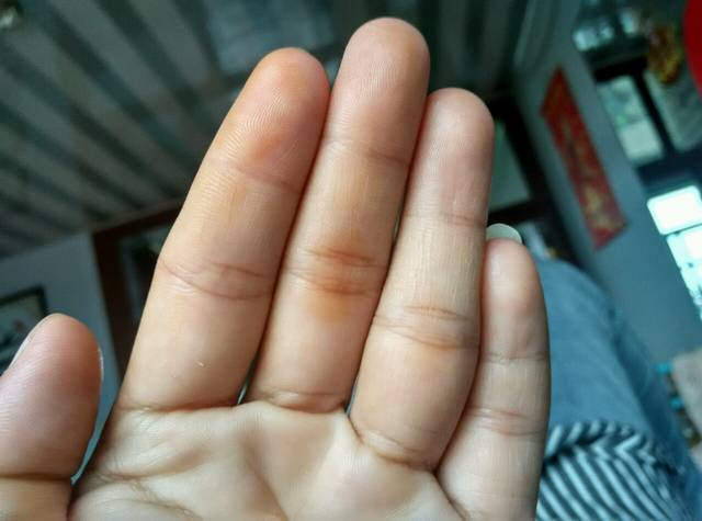 单手手指发黄是什么原因