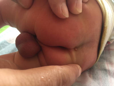 宝宝出生第一天屁股沟就有个小米粒大小的肉粒,现在五天了,肉芽长得大