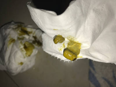 宝宝七个月最近拉肚子,昨天发烧,到今天,宝宝拉便便裏面伴有疙瘩绿色