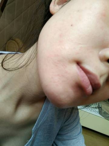 怀孕皮肤过敏,长白色水泡,是湿疹吗?