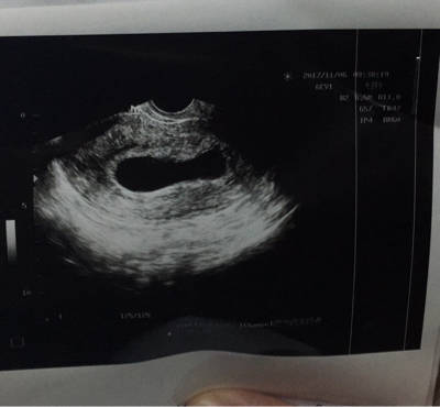 怀孕7周胎儿彩超图图片