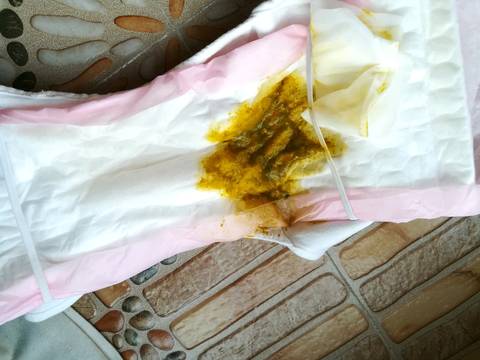 两个月大宝宝拉屎这样正常吗?