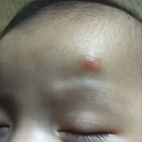 宝宝是否生冻疮,还是被蚊子咬