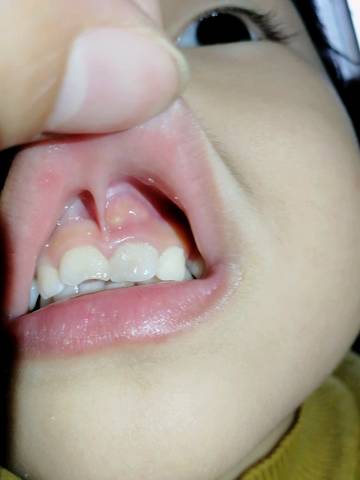 三周孩子牙齿磕了下牙龈起脓包了!急急