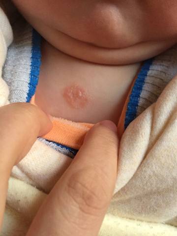 六个月宝宝胸口白斑图图片