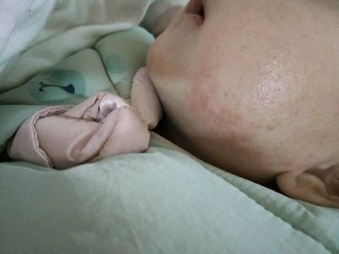 宝宝花粉过敏症状图片图片