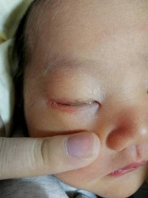 宝宝出生7天老是流眼屎,眼皮都红了,怎麼办
