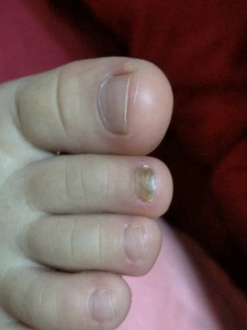 宝宝剪指甲长成这样是什麼原因?是不是灰指甲?