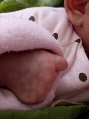 宝宝皮肤发紫发花网状图片