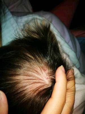 婴儿头皮发红图片图片