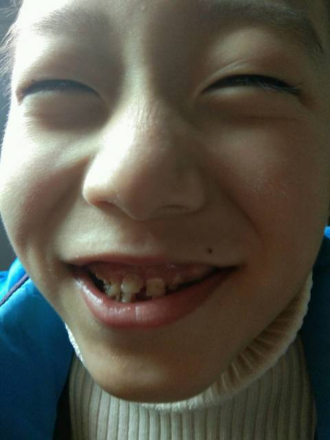 第一颗门牙光荣下岗