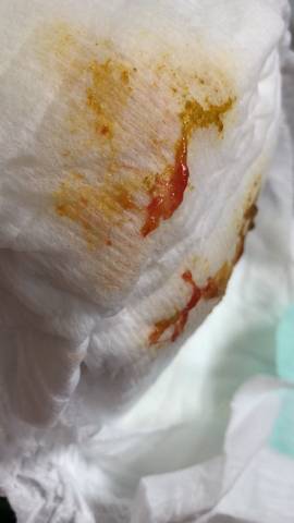 宝宝便血,肛裂还是过敏?