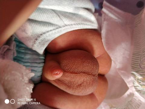 新生儿睾丸图图片