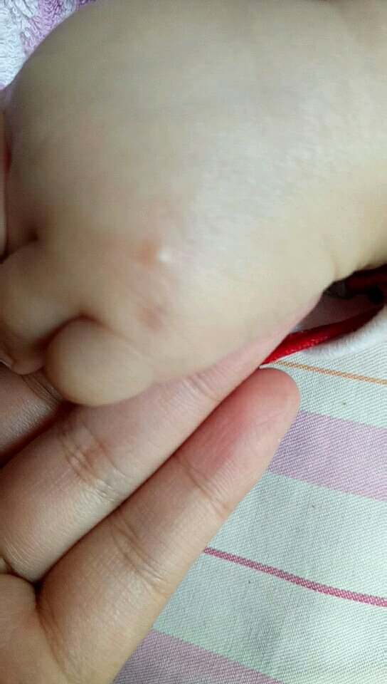五个半月宝宝脸上鼓水泡状痘痘是什么