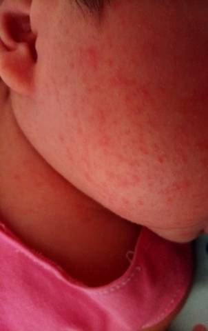 宝宝一个多月脸上长好多痘痘,睡觉脸哪侧在下面,哪侧就长,请问这是什