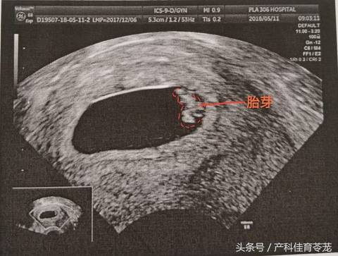 三,胎芽(fetal pole)