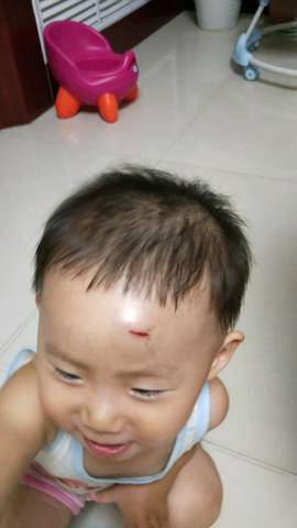 宝宝不小心撞破了头 有个口子都流血了 还肿了 该怎么处理伤口 宝宝树