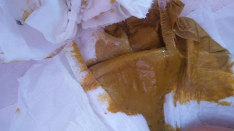 宝宝最近两次拉的臭臭,是拉肚子吗?有什么好办法吗?已经第二天了