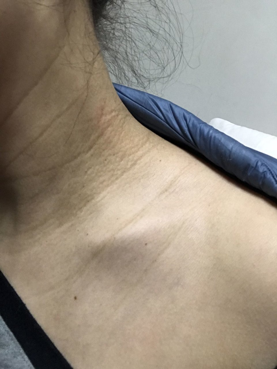 怀孕长颈纹会消吗
