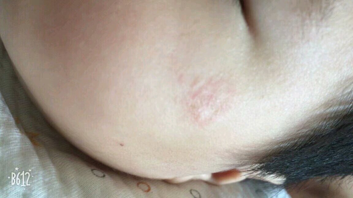 好怕会有疤