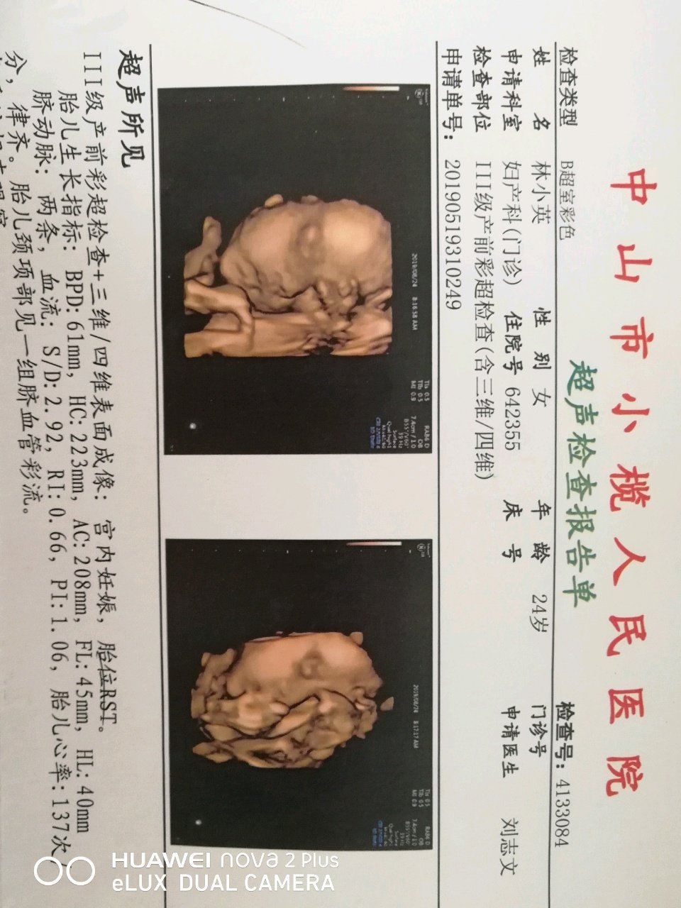 四维彩超结果，有会看男女的吗？