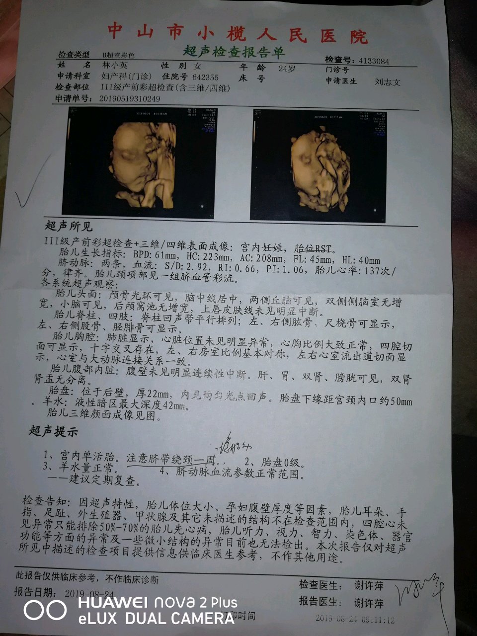 四维彩超结果，有会看男女的吗？