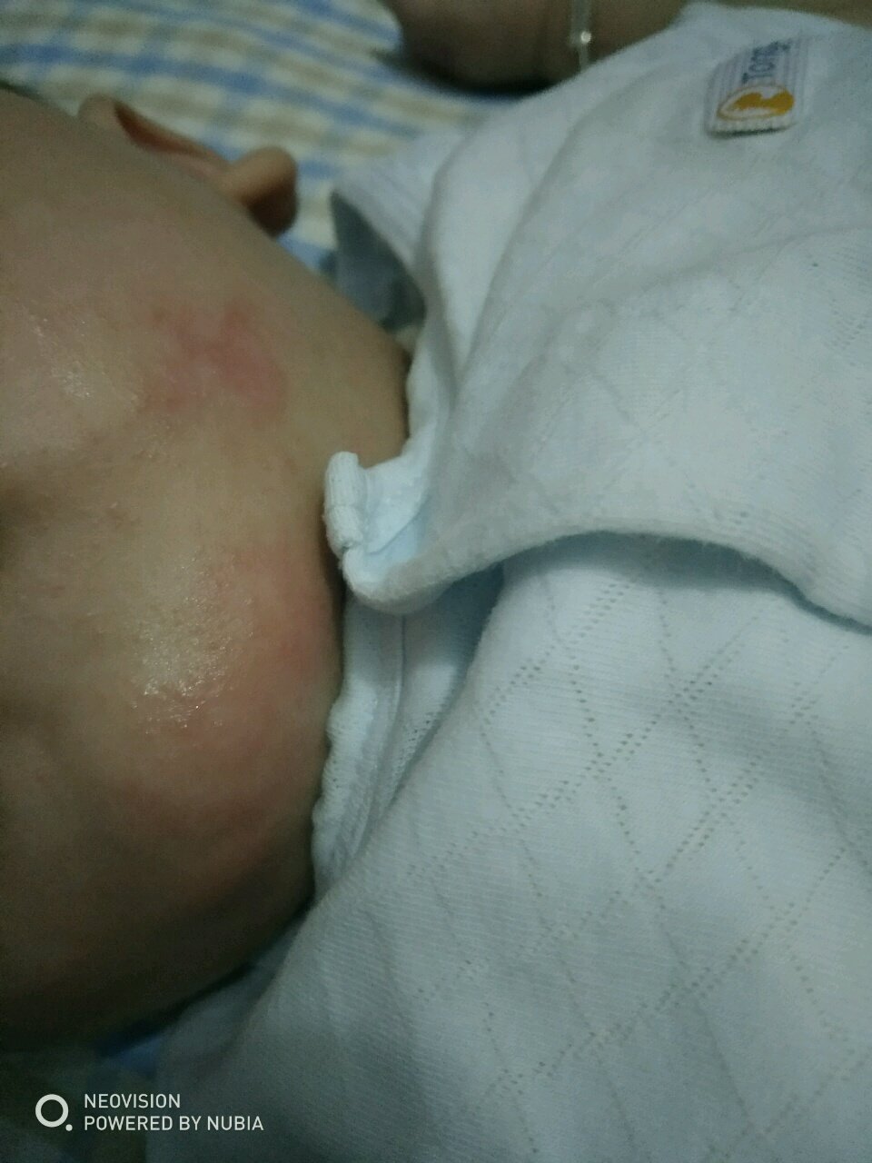 这是湿疹吗，抹什么药膏管用啊，谢谢大家