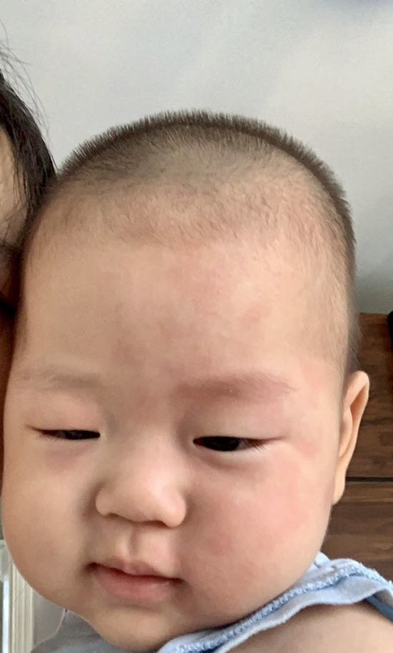八个月宝宝莫名起疙瘩，是急性过敏吗