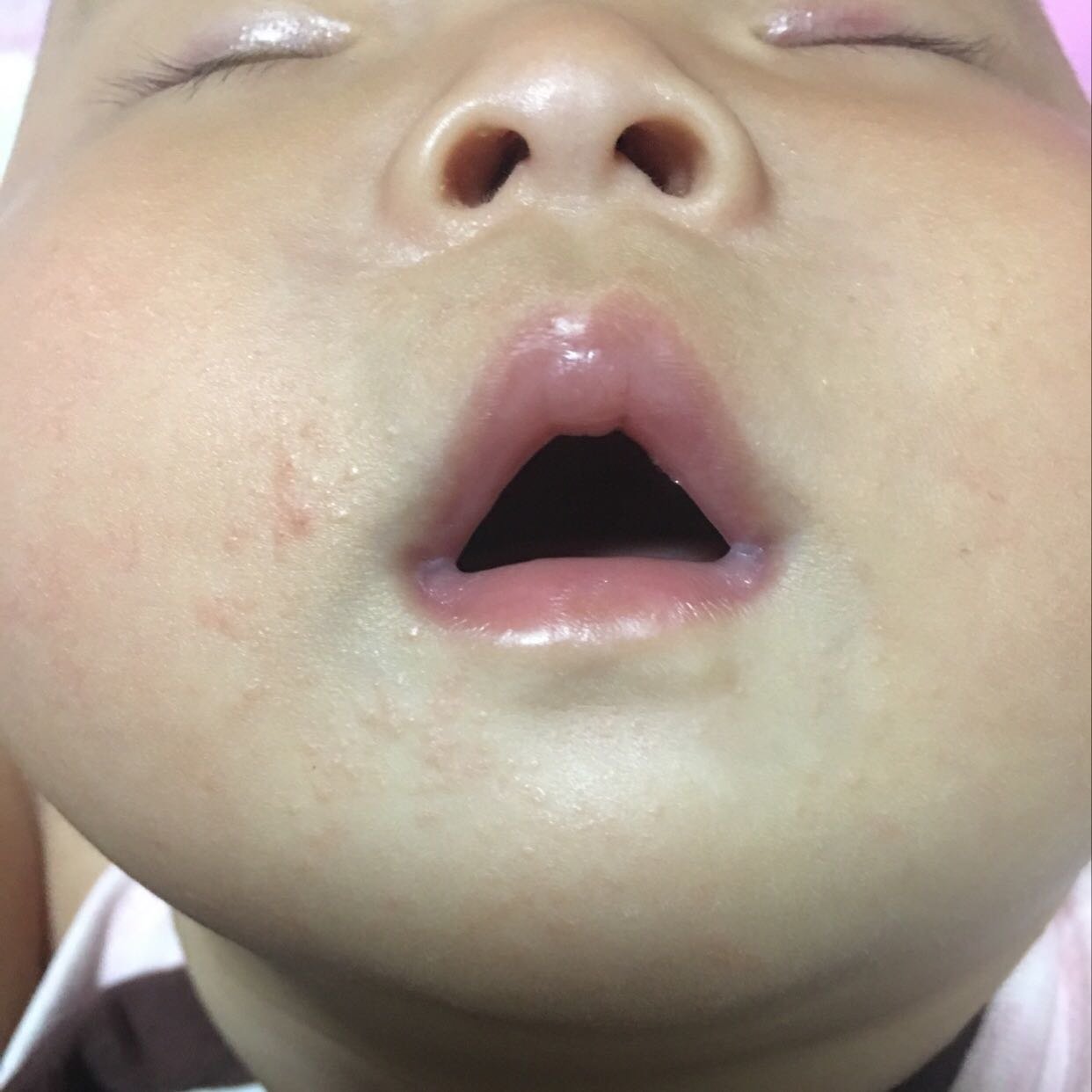 嘴巴边上冒出好多痘痘