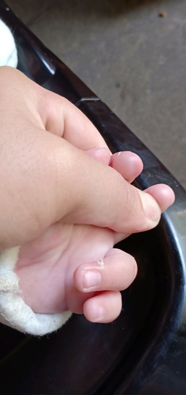 不小心把宝宝给烫伤起泡了
