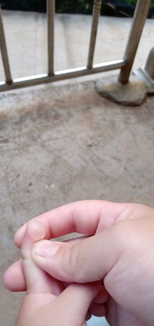 不小心把宝宝给烫伤起泡了