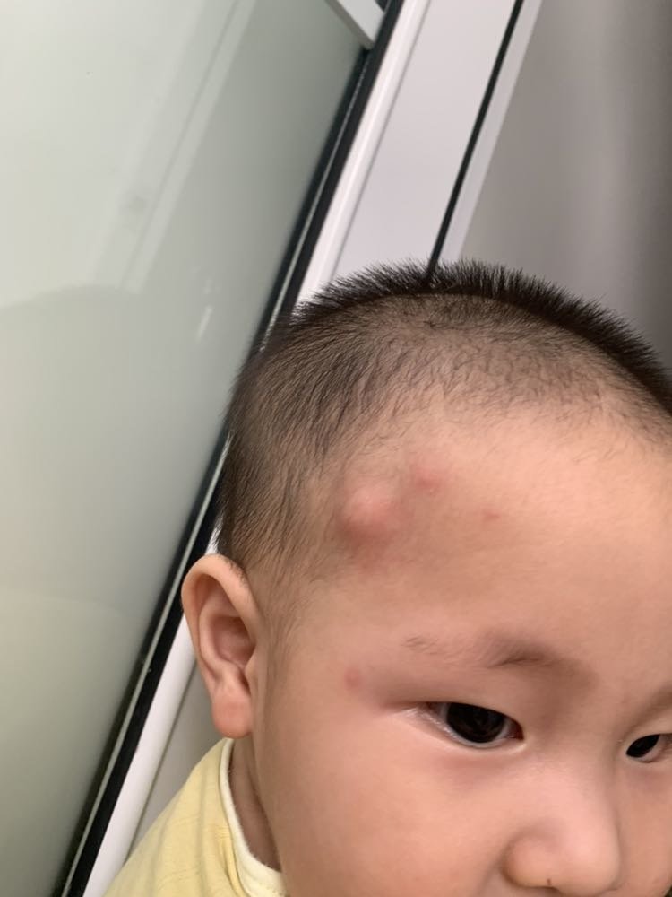 额头长了几个鼓鼓的包