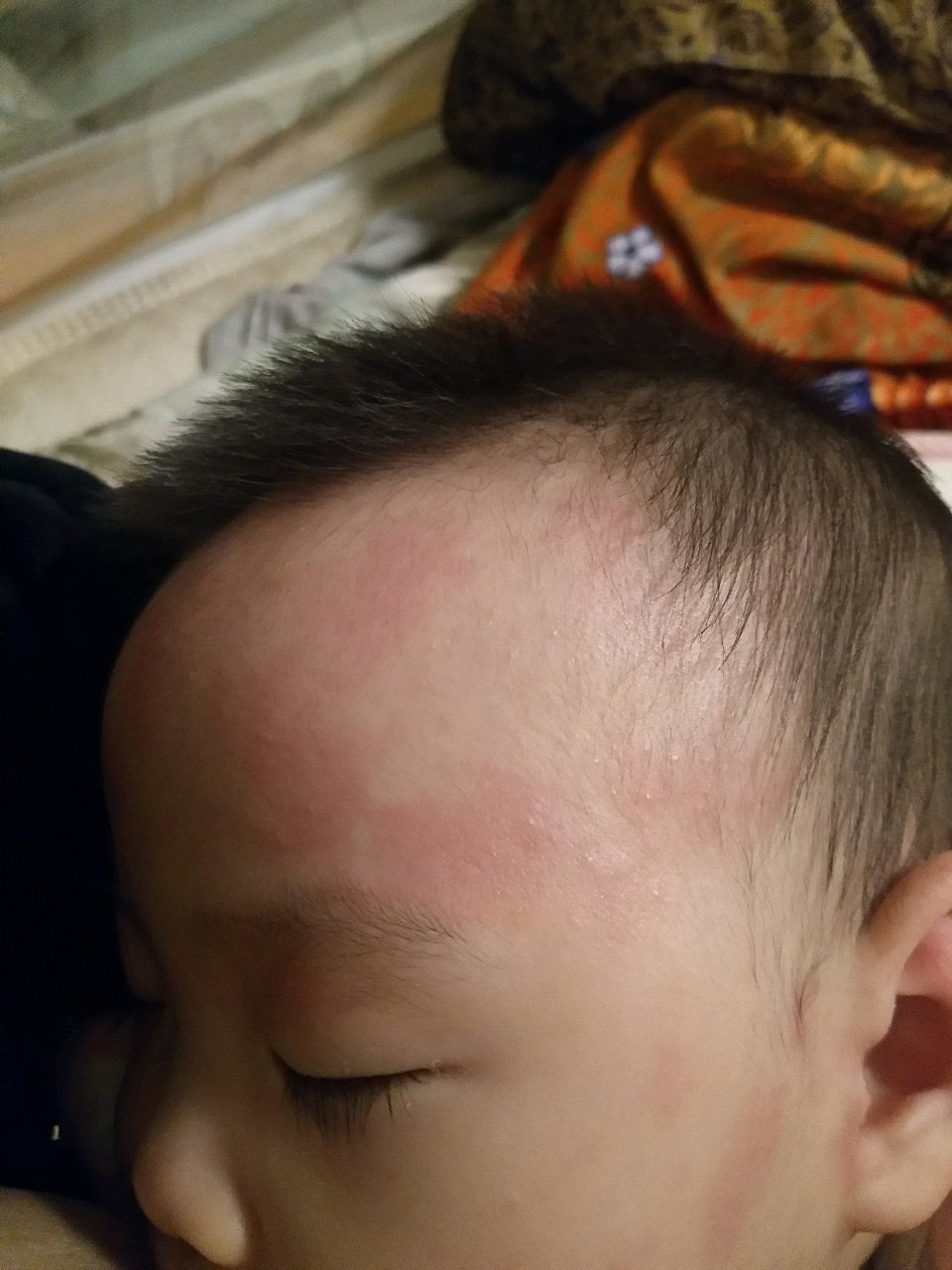 宝宝脸上长米米，很红