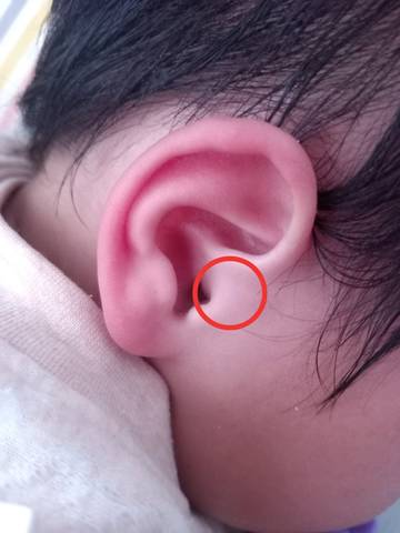 宝宝感冒引起的,去医院也说是中耳炎,刚开始吃阿莫西林,后来看了医生