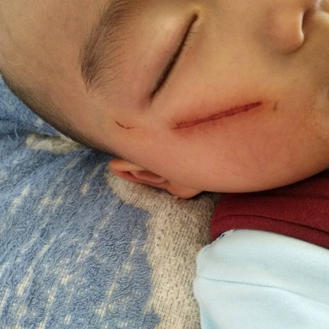 宝宝的脸被同龄小朋友指甲抓破一层皮,有轻微出血,会留疤吗?