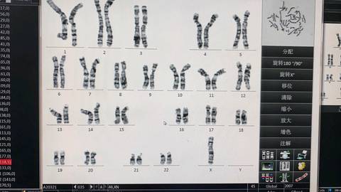 fish显示21三体嵌合核型没有发现任何问题怎么决定