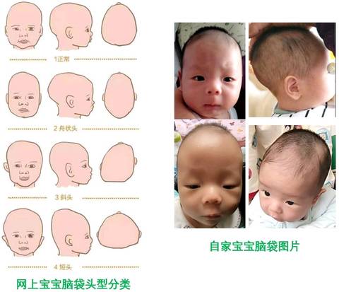 请问我家宝宝头型是舟状头吗？下面有图片，请专家和宝妈鉴别下，谢谢！_育儿问答_宝宝树