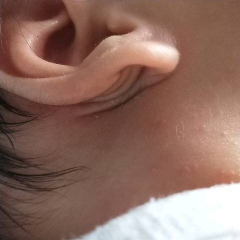 宝宝耳朵后的小包图片