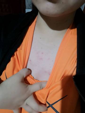 从怀孕三个月后胸前就开始长这种痘痘了,都不知道这是什么鬼,(;(;`)有
