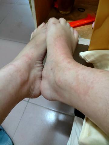 每天晚上回到家脚就是这样红肿,特别痒,亲们有谁知道是什么原因吗!