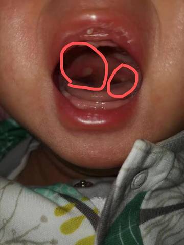 宝宝2个多月 嘴巴里长了白点 不知道是口腔溃疡还是鹅口疮 请问大家