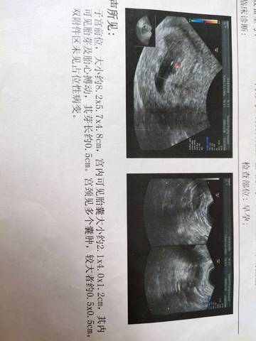 三个月的孕囊形状图片图片