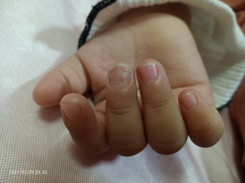 两周岁女包手指甲坑坑洼洼的,先是只有一个指甲图2的情况,后面变严重