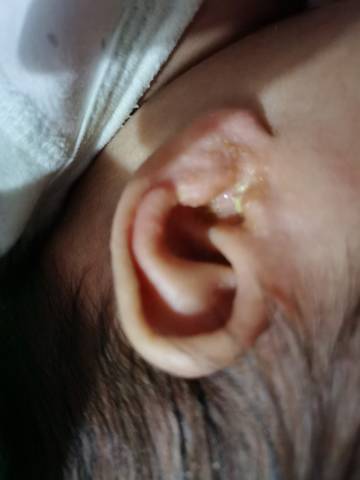 宝宝耳朵外有很多分泌物,还有点渗水有没有亲晓得是怎么回事呀?