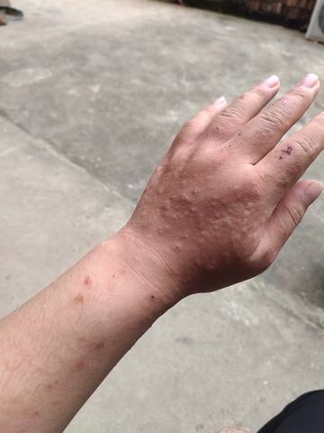 孕晚期手脚很痒!都抓出血,反反复复的痒!就是这个样子!