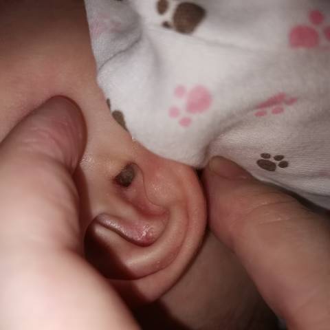 这是不是中耳炎啊,刚刚给宝贝看看耳朵发现有点像脓一样的东西,只有
